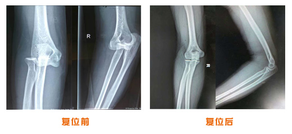 復(fù)位前后對比